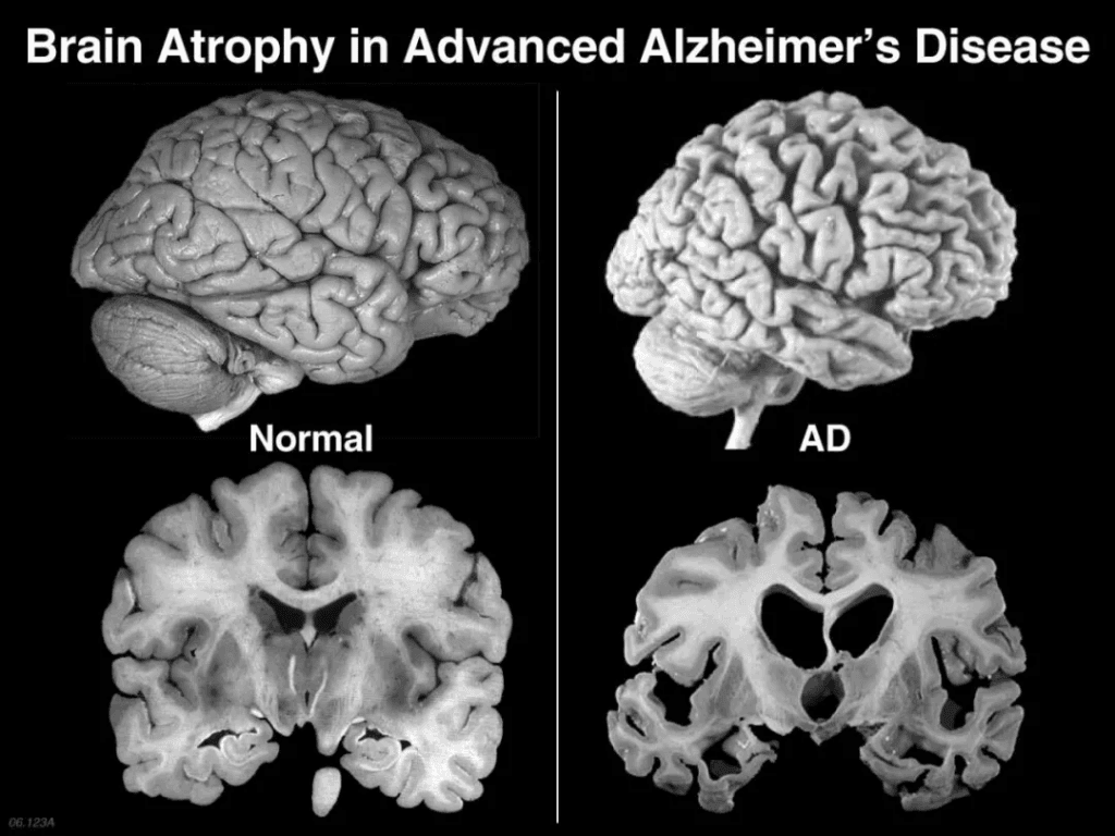Brain damage is the cause of Alzheimer's disease